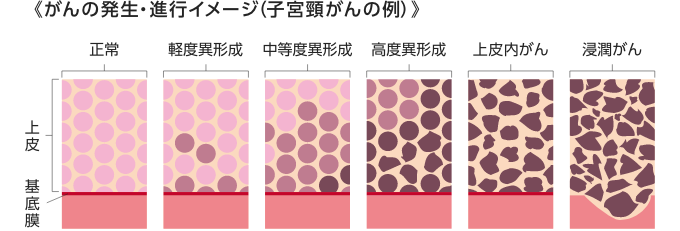 がん発生・進行イメージ（子宮頸がんの例）